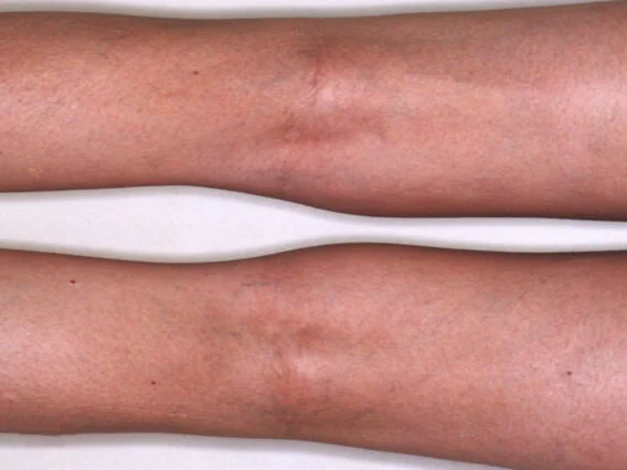 After SCLEROTHERAPY